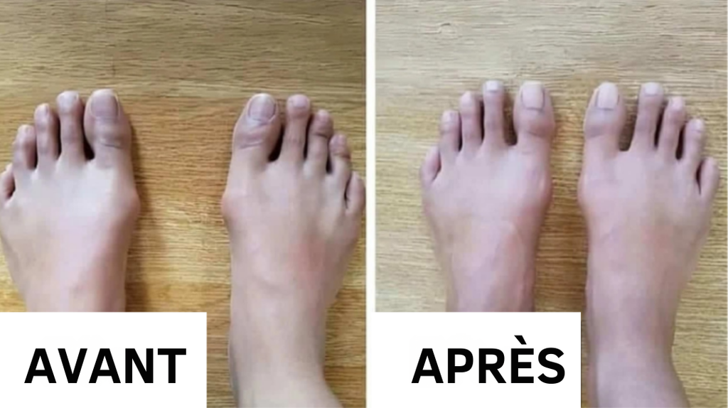 Ortisoin™ Correcteur d’Hallux Valgus | Corrige l’alignement de l’orteil en seulement 14 jours