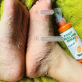 Stop aux Pieds Secs – Spray Exfoliant Pieds Anti-Callosités