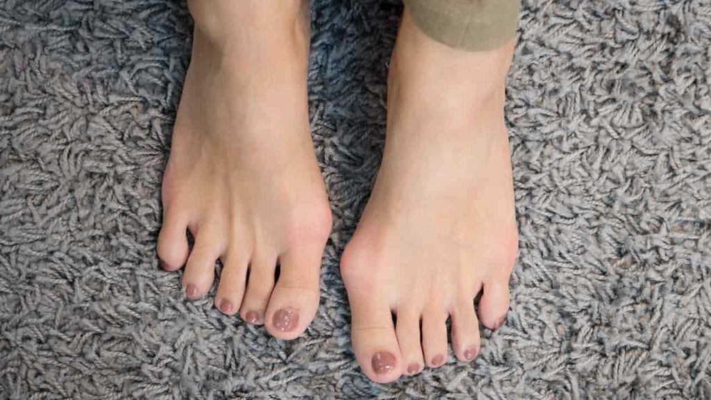 Ortisoin™ Correcteur d’Hallux Valgus | Corrige l’alignement de l’orteil en seulement 14 jours
