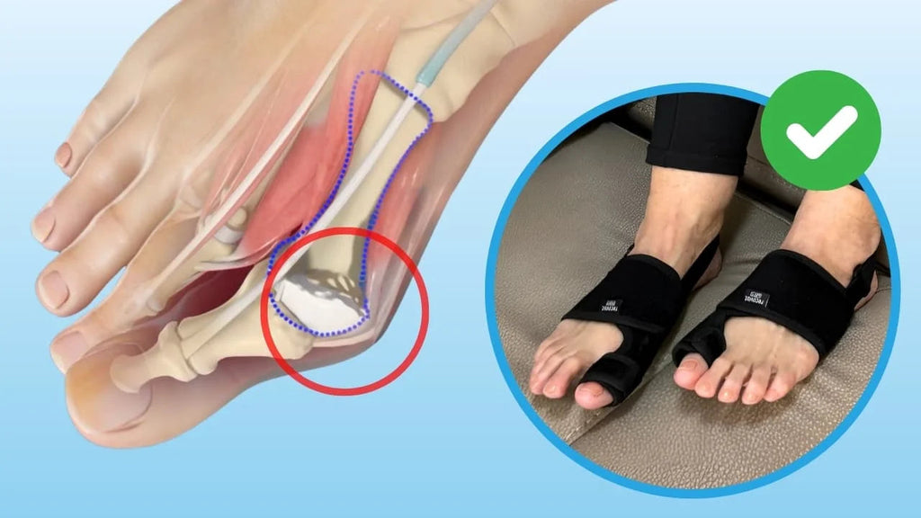 Ortisoin™ Correcteur d’Hallux Valgus | Corrige l’alignement de l’orteil en seulement 14 jours
