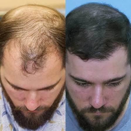 Le spray ULTRA HAIR GROWTH