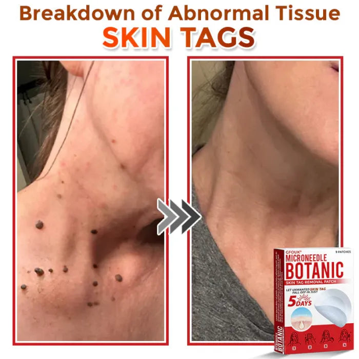 Skin tag removal patches