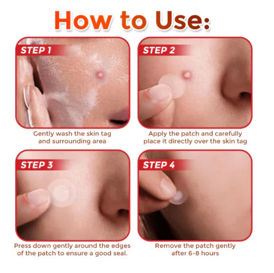 Skin tag removal patches